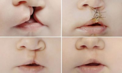 Smile Restoration: Understanding Cleft Lip and Palate Repairs