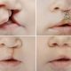 Smile Restoration: Understanding Cleft Lip and Palate Repairs