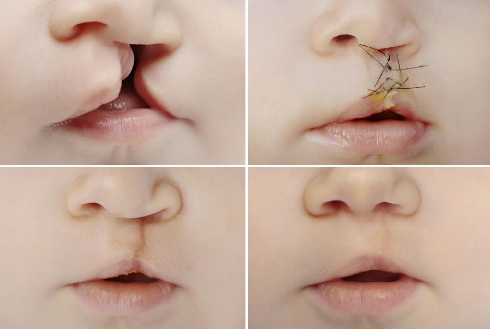 Smile Restoration: Understanding Cleft Lip and Palate Repairs