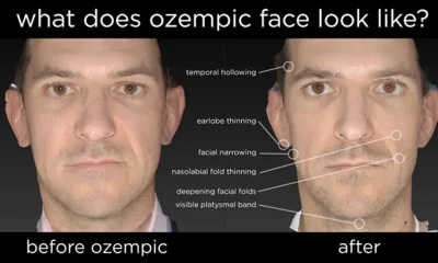 Ozempic Face: The Surgeon's New Challenge in Aesthetic Medicine