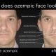 Ozempic Face: The Surgeon's New Challenge in Aesthetic Medicine