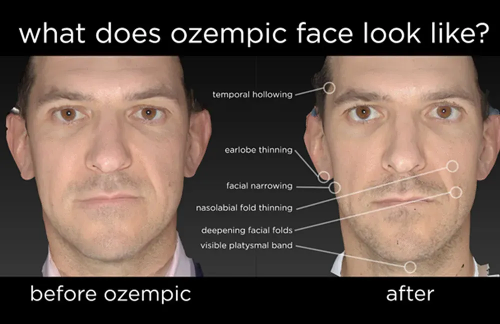 Ozempic Face: The Surgeon's New Challenge in Aesthetic Medicine