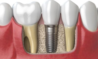 Dental Implants: The Modern Solution for Missing Teeth