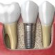 Dental Implants: The Modern Solution for Missing Teeth