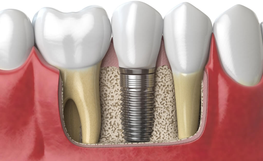 Dental Implants: The Modern Solution for Missing Teeth